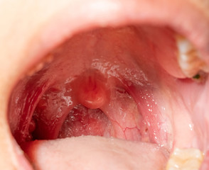 Sore throat with throat swollen. Closeup open mouth with posterior pharyngeal wall swelling and...