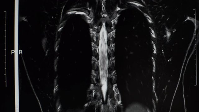 Magnetic resonance imaging of the spine of a man