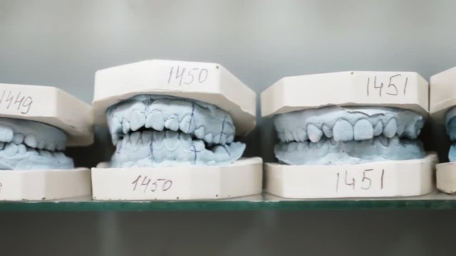 Dental gypsum models cast of a human dental jaw