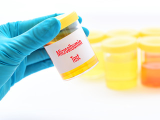Urine sample for microalbumin test, diagnosis for diabetes and renal disease
