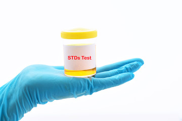 Urine sample for sexually transmitted diseases or STDs test
