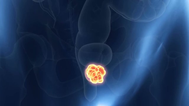 Tumours in the prostate gland