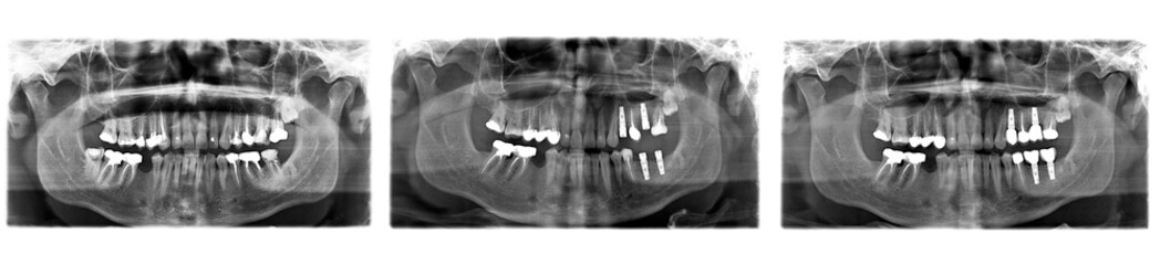 X ray of teeth