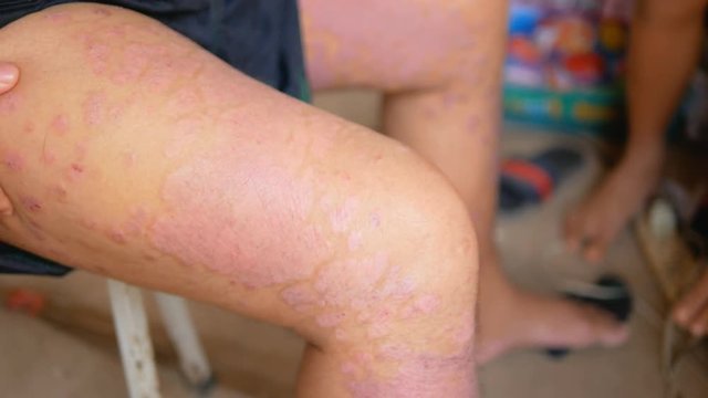 Psoriasis patients use herbal medicines to use their own legs with wounds. Diseases caused by abnormalities of the lymph and a skin disease.