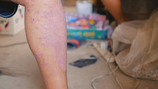 Psoriasis patients use herbal medicines to use their own legs with wounds. Diseases caused by abnormalities of the lymph and a skin disease.