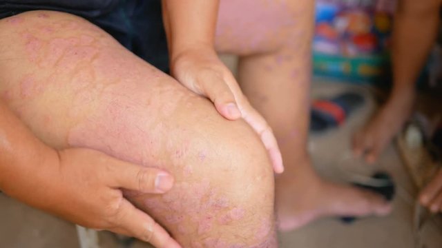 Psoriasis patients use herbal medicines to use their own legs with wounds. Diseases caused by abnormalities of the lymph and a skin disease.