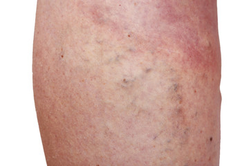 Fototapeta premium The varicose veins