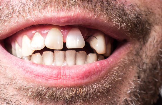 Zahnlücke nach einer Zysten Operation