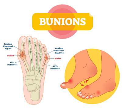 Bunions vector illustration. Labeled feet bone disorder explanation scheme.