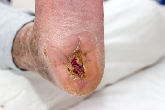 ulcer on a diabetic foot