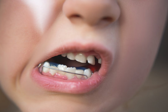 Photo of a little girl's mouth with an orthodontic appliance and crooked teeth.