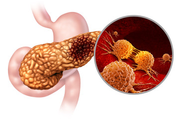 Pancreatic Cancer Anatomy