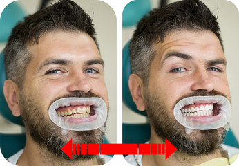 Teeth yellow vs white, before or after whitening. Man with isolated background touching mouth with...