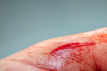 One photo of a series of photos taken of a fresh bleeding cut development over a priod of 90 minutes