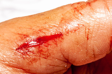 One photo of a series of photos taken of a fresh bleeding cut development over a priod of 90 minutes