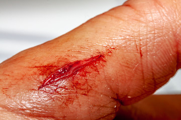 One photo of a series of photos taken of a fresh bleeding cut development over a priod of 90 minutes