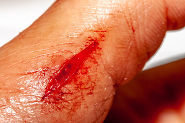 One photo of a series of photos taken of a fresh bleeding cut development over a priod of 90 minutes