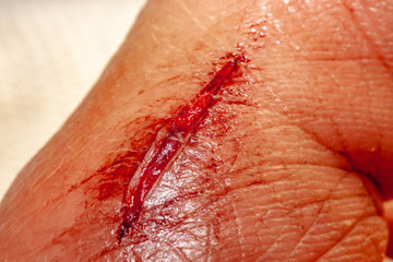 One photo of a series of photos taken of a fresh bleeding cut development over a priod of 90 minutes