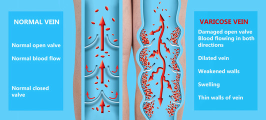 Varicose veins on a female senior legs. The structure of normal and varicose veins.