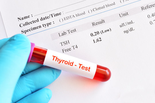 Blood sample tube with abnormal thyroid hormone test result