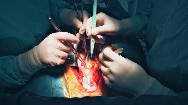 Operator doctors doing open heart surgery Closeup of coronary artery bypass graft surgery.