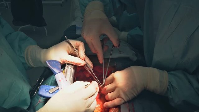 Heart surgery. Open heart surgery suture greater saphenous vein coronary artery bypass surgery