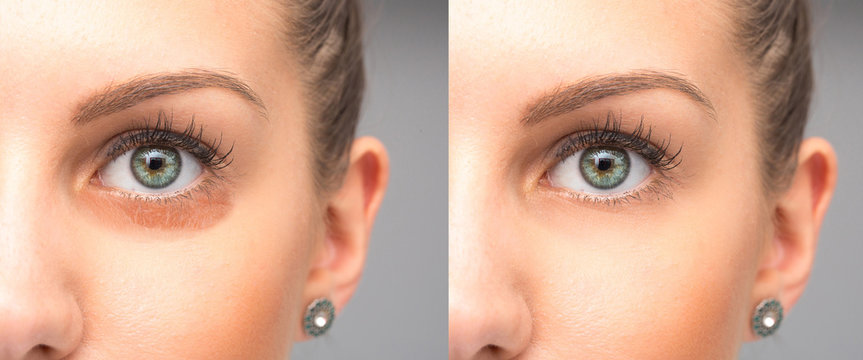 Puffiness under eyes removal before and after treatment