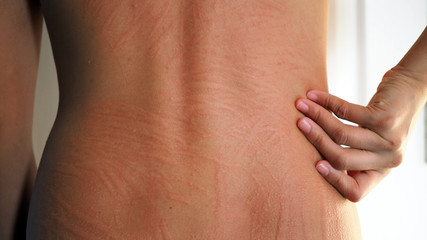 Allergic rash dermatitis eczema on skin. Urticaria.