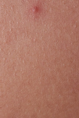 Human skin texture with red pimple