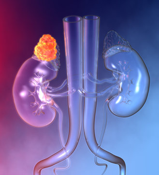 Adrenal glands tumo, colorful medically 3D illustration