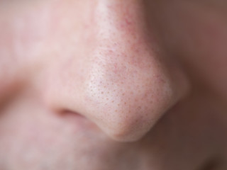 Pimple blackheads on the nose. Close up.