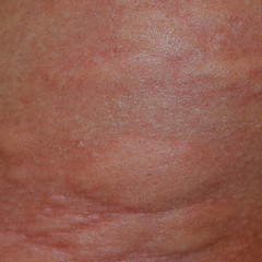 Fototapeta premium Allergy skin back and sides. Allergic reactions on the skin in the form of swelling and redness