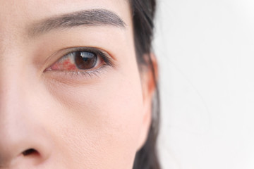 red eye. conjunctivitis or irritation of sensitive eyes.