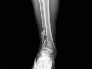 x-ray of a fracture human bone