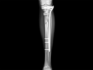 x-ray showing treatment of fracture tibia with plate and screw