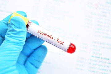 Blood sample tube for chickenpox or varicella virus test