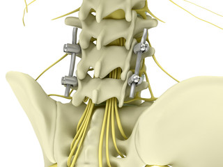 Metal pedicle screw fixation system in the lumbar spine isolated on white background 3d illustration