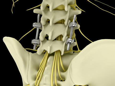 Metal pedicle screw fixation system in the lumbar spine isolated on black background 3d illustration