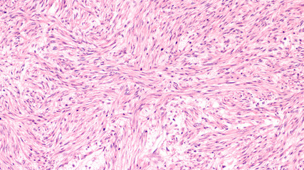 Microscopic image of a leiomyosarcoma, a type of soft tissue sarcoma of smooth muscle.  This malignant tumor typically occurs in the uterus or GI tract, but can occur from blood vessels elsewhere. 