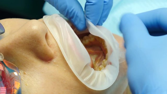 Tooth treatment. Closeup shot of female dentist assistant in gloves putting on installing sterile mouth expander. Preparation for medical examination. dentist in his office prepares expander for mouth
