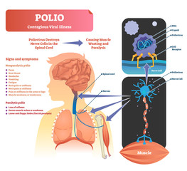 Polio vector illustration. Labeled medical virus infection symptoms scheme. - obrazy, fototapety, plakaty