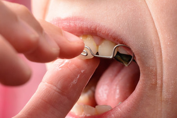A big plan for dressing a metal plate for tooth bristling