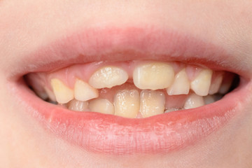Close-up of a small boy with curved teeth smiling