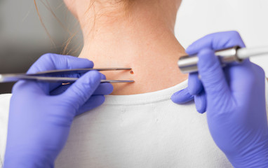 Patient getting laser mole removal. skin moles treatment.