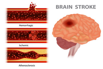 Types of stroke: Atherosclerosis, Ischemic, Hemorrhagic - obrazy, fototapety, plakaty