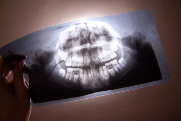 Panoramic dental x-ray of child photo with milk teeth and first molar teeth. in doctor hand. selective focus. Health care, dental hygiene and happy childhood concept.