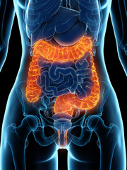 3d rendered medically accurate illustration of a diseased colon