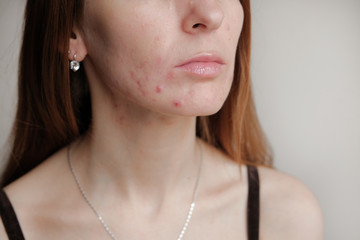 Woman with problem skin. Teen acne on young skin.