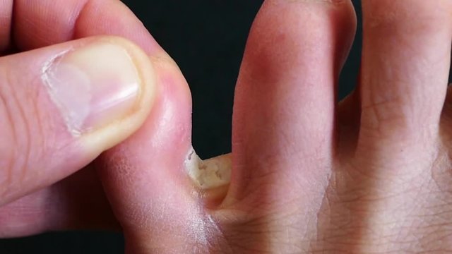 athlete's foot, ringworm between the toes, Fungal disease between toes, a human foot with foot care, neglected and fungal disease,