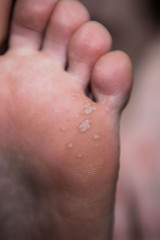 Corn on foot close up